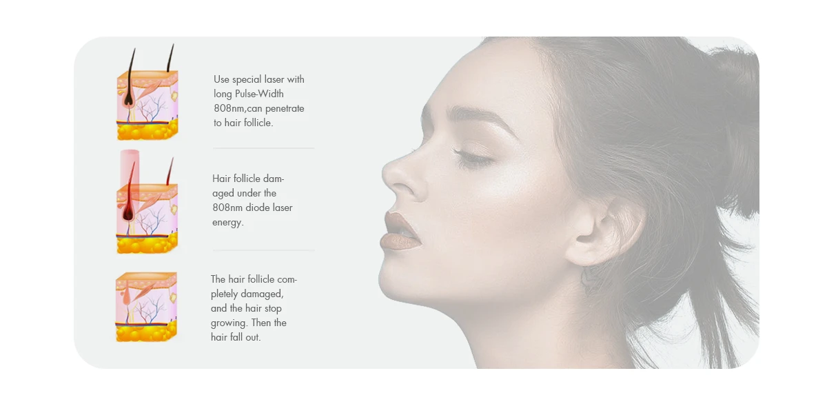 sanhe Diode Laser Hair Removal sanhe Diode Laser Hair Removal
